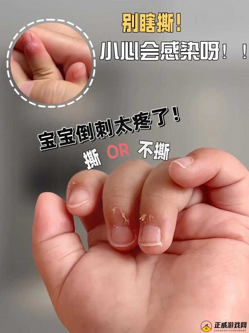 宝宝手指痛：为何三根手指就疼？